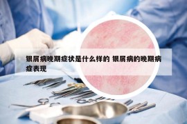 银屑病晚期症状是什么样的 银屑病的晚期病症表现