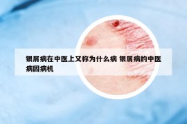 银屑病在中医上又称为什么病 银屑病的中医病因病机