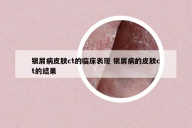 银屑病皮肤ct的临床表现 银屑病的皮肤ct的结果