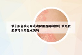 掌砋脓包病可用硫磺粉用酒调和擦吗 掌跖脓疱病可以用盐水洗吗