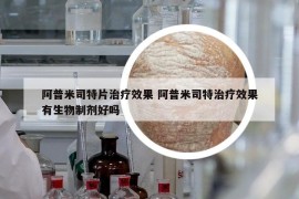 阿普米司特片治疗效果 阿普米司特治疗效果有生物制剂好吗