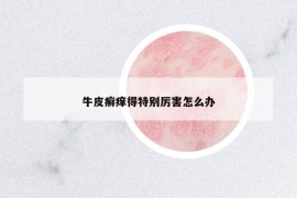 牛皮癣痒得特别厉害怎么办