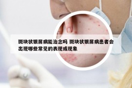斑块状银屑病能治念吗 斑块状银屑病患者会出现哪些常见的表现或现象