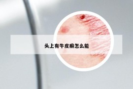 头上有牛皮癣怎么能