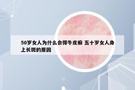 50岁女人为什么会得牛皮癣 五十岁女人身上长斑的原因