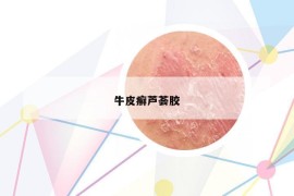 牛皮癣芦荟胶