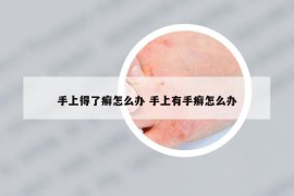 手上得了癣怎么办 手上有手癣怎么办