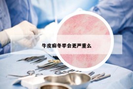 牛皮癣冬季会更严重么