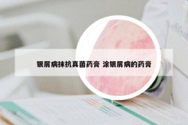 银屑病抹抗真菌药膏 涂银屑病的药膏