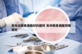 贵阳治银屑病最好的医院 贵州银屑病医院哪家好