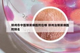 郑州市中医银屑病医院在哪 郑州治银屑病医院排名