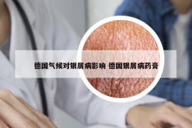 德国气候对银屑病影响 德国银屑病药膏