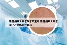 银屑病眼鼻喉老发了严重吗 银屑病眼鼻喉老发了严重吗吃什么药