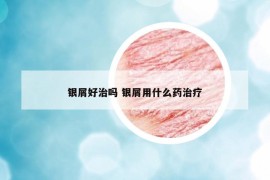 银屑好治吗 银屑用什么药治疗