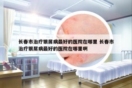 长春市治疗银屑病最好的医院在哪里 长春市治疗银屑病最好的医院在哪里啊