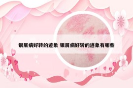 银屑病好转的迹象 银屑病好转的迹象有哪些