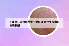牛皮癣打生物制剂要不要忌口 治疗牛皮癣打生物制剂