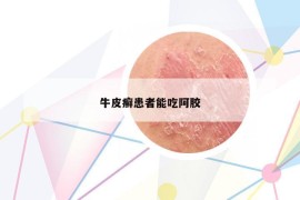 牛皮癣患者能吃阿胶