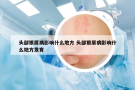 头部银屑病影响什么地方 头部银屑病影响什么地方发育