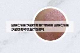 盐酸左氧氟沙星胶囊治疗银屑病 盐酸左氧氟沙星胶囊可以治疗性病吗