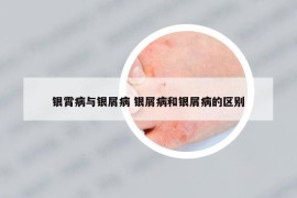 银霄病与银屑病 银屑病和银屑病的区别