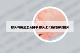 额头有癣是怎么回事 额头上长癣的症状图片