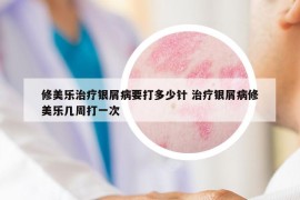 修美乐治疗银屑病要打多少针 治疗银屑病修美乐几周打一次