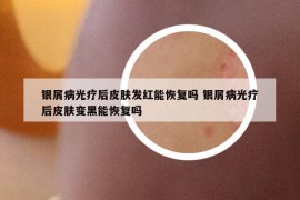 银屑病光疗后皮肤发红能恢复吗 银屑病光疗后皮肤变黑能恢复吗