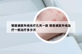 银屑病紫外线光疗几天一做 银屑病紫外线治疗一般治疗多少次