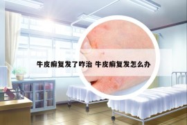 牛皮癣复发了咋治 牛皮癣复发怎么办