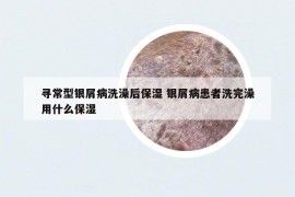 寻常型银屑病洗澡后保湿 银屑病患者洗完澡用什么保湿