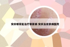安庆哪家能治疗银屑病 安庆治皮肤病医院