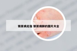 银屑病足指 银屑病脚的图片大全