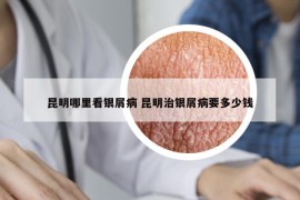 昆明哪里看银屑病 昆明治银屑病要多少钱