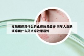 皮肤瘙痒用什么药止痒效果最好 老年人皮肤瘙痒用什么药止痒效果最好