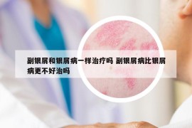 副银屑和银屑病一样治疗吗 副银屑病比银屑病更不好治吗