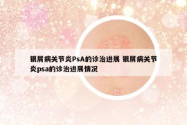 银屑病关节炎PsA的诊治进展 银屑病关节炎psa的诊治进展情况