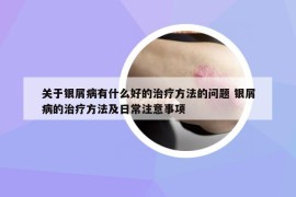 关于银屑病有什么好的治疗方法的问题 银屑病的治疗方法及日常注意事项