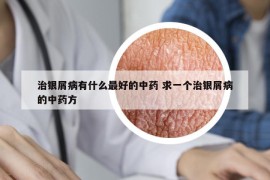 治银屑病有什么最好的中药 求一个治银屑病的中药方
