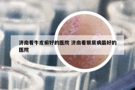 济南看牛皮癣好的医院 济南看银屑病最好的医院