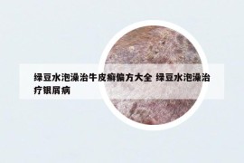 绿豆水泡澡治牛皮癣偏方大全 绿豆水泡澡治疗银屑病