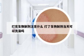 打完生物制剂注意什么 打了生物制剂当天可以洗澡吗