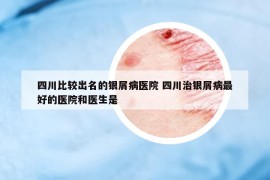 四川比较出名的银屑病医院 四川治银屑病最好的医院和医生是