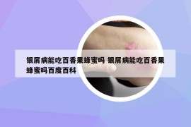 银屑病能吃百香果蜂蜜吗 银屑病能吃百香果蜂蜜吗百度百科