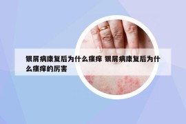 银屑病康复后为什么瘙痒 银屑病康复后为什么瘙痒的厉害