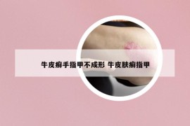 牛皮癣手指甲不成形 牛皮肤癣指甲