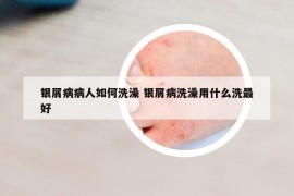 银屑病病人如何洗澡 银屑病洗澡用什么洗最好