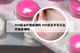 999能治疗银屑病吗 999皮炎平可以治疗银屑病吗