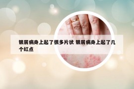 银屑病身上起了很多片状 银屑病身上起了几个红点