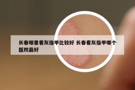 长春哪里看灰指甲比较好 长春看灰指甲哪个医院最好